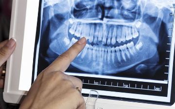 У пациентов с COVID-19 начали выпадать зубы