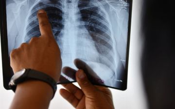 За прошедшие сутки у 59 узбекистанцев выявили пневмонию - статистика