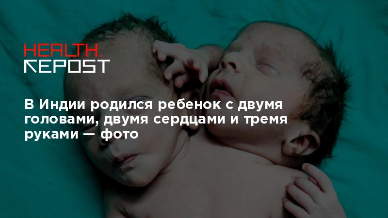 В Индии родился ребенок с сердцем наружу из-за редкого заболевания — Курьезы